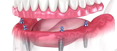 dental implants greensburg pa|All.